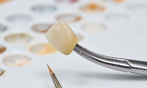 Quarree Dental - Implantat