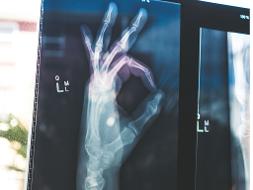 Röntgenbild von einer Hand, die ein ok-Zeichen macht.