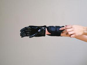 Eine Handprothese an einem Menschen