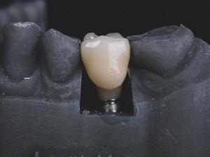 Modell eines Zahnimplantats in einem Gebiss.