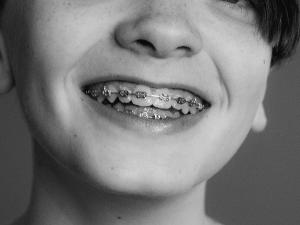 schwarz-weiß Bild mit dem Gesicht eines Jungens mit Zahnspange