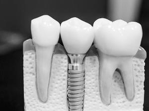 Drei Zähne als Modell dargestellt.