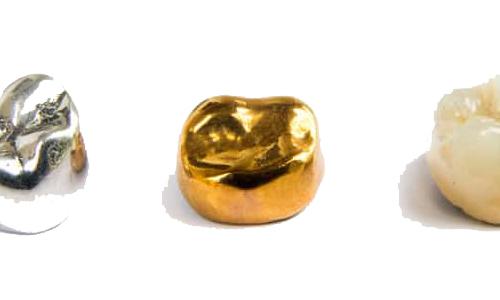 Ein Goldzahn liegt neben einem silber- und einem normalen Zahn